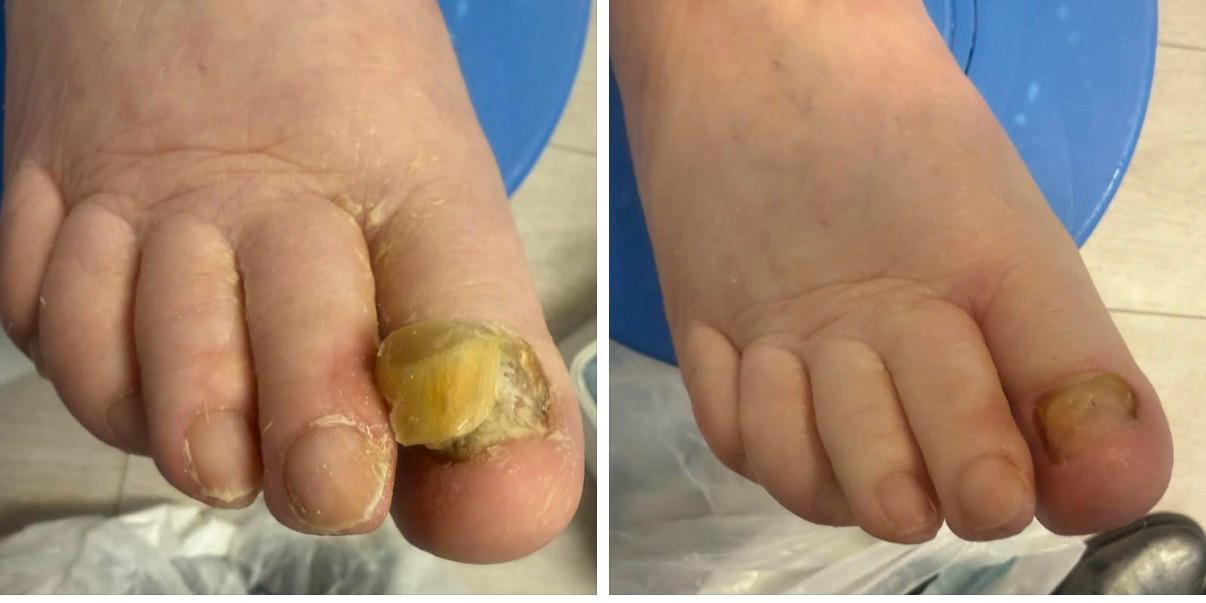 Before and after foot treatment results